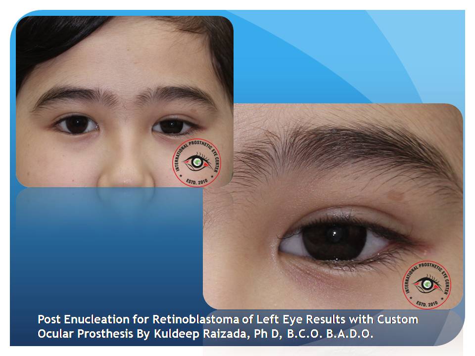 Custom Artificial Eyes Worlds Best Artificial Eye Center
